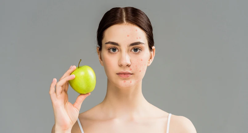 Diet and Acne